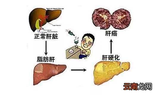 脂肪肝的症状及表现 脂肪肝有哪些症状
