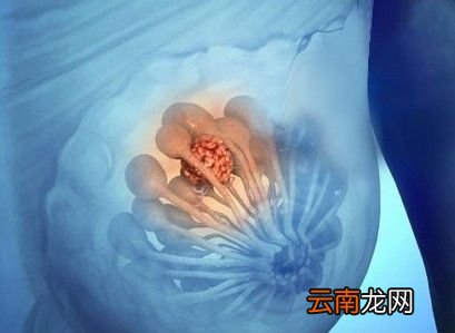 乳腺增生是怎么形成 乳腺增生的原因分析