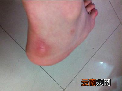 跟腱炎会引起发烧吗