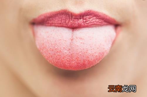 通过舌苔看健康状况 不同颜色舌苔对应不同病症