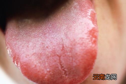 通过舌苔看健康状况 不同颜色舌苔对应不同病症