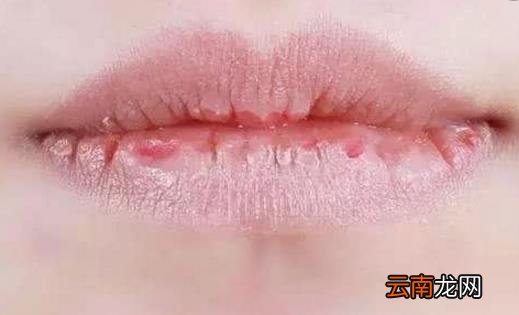 嘴唇干裂的原因 嘴唇干裂治疗小偏方