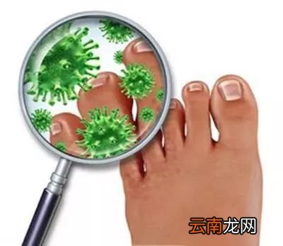 根治脚气的偏方 怎么彻底根治脚气好