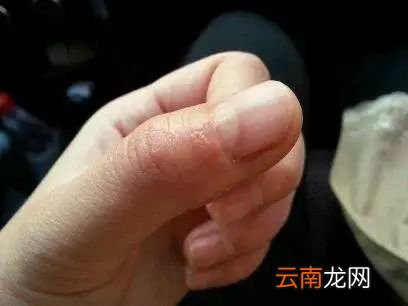糖尿病的早期症状 怎样预防糖尿病好