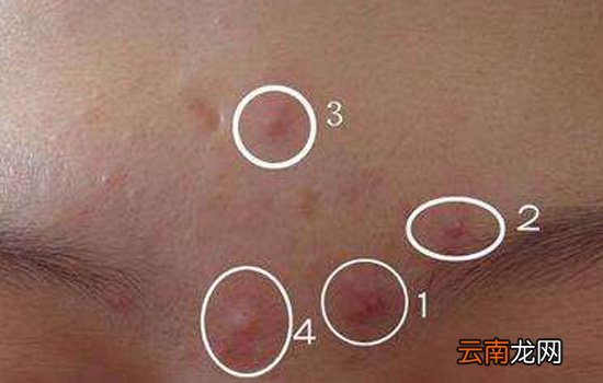 薏米可以治扁平疣吗 薏米治疗扁平疣的方法