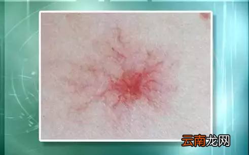 肝脏不好的症状 肝不好的人眼睛会出卖你