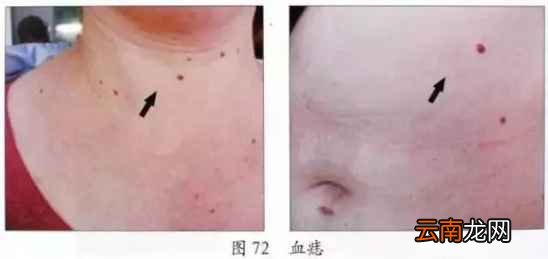 肝脏不好的症状 肝不好的人眼睛会出卖你