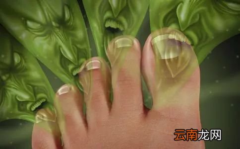 治脚气的方法 几种有效根治脚气方法