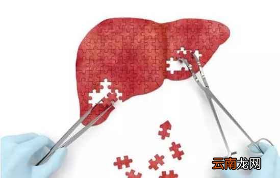 肝硬化早期症状 肝硬化怎么调节好