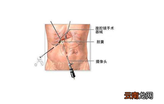 缓解胆囊疼痛的小妙招 必要时需手术切除胆囊