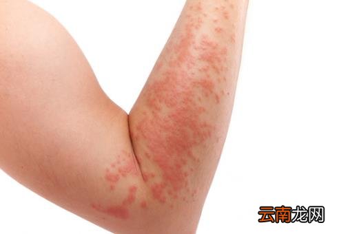 春季易引发的皮肤病 几种方法助你轻松应对