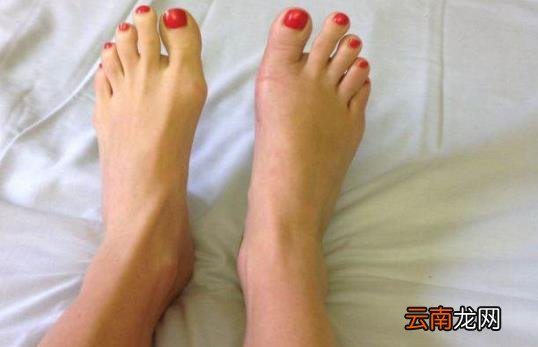 早上起来脚心疼怎么办？
