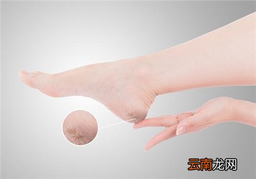 夏天脚后跟开裂是什么原因 夏天脚后跟开裂怎么办
