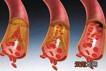血管堵塞吃什么好 预防血压是关键