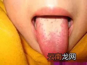 止咳偏方简单有效 咳嗽总不好怎么办