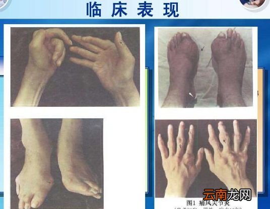 尿酸高有什么危害吗 用它泡水喝尿酸轻松降