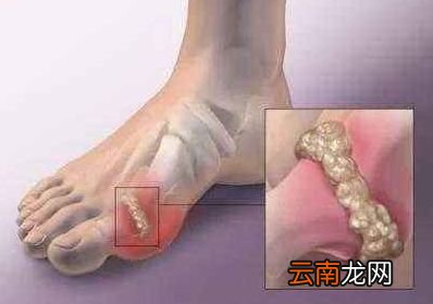 尿酸高有什么危害吗 用它泡水喝尿酸轻松降