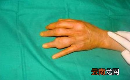 尿酸高有什么危害吗 用它泡水喝尿酸轻松降